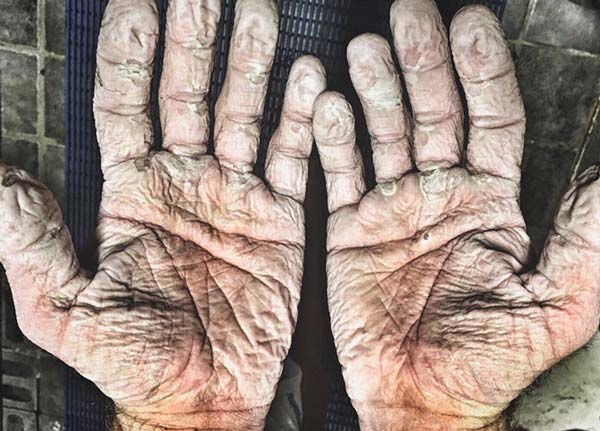 Това са дланите на 33-годишен спортист. Ето как се е докарал до това състояние: