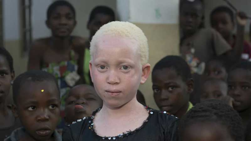 албинос