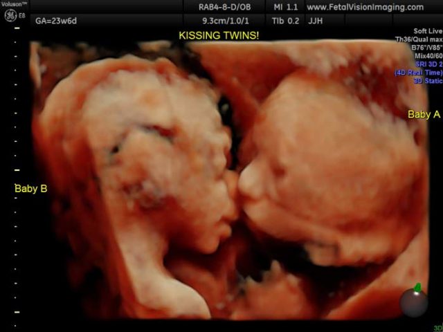 Затрогващо! Снимка от ултразвук показва целуващи се близнаци в утробата