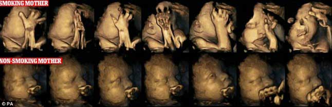 Нероденото дете буквално се гърчи когато майката пуши демонстрирайки пагубното