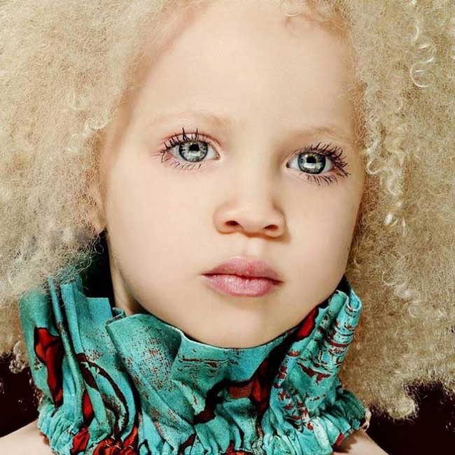 Албинизъм е рядка генетична особеност свързана с липсата на пигмента