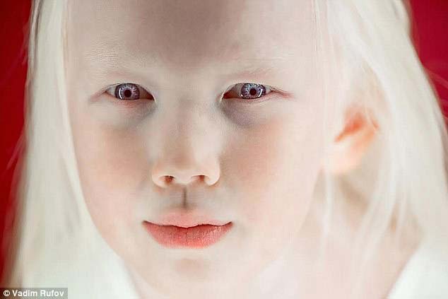 момиче албинос със сини очи