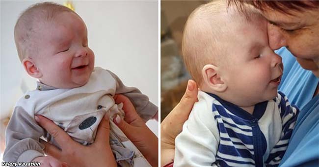 Осеммесечният Александър К е роден в Томск Русия без очни