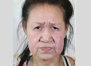 След пластични операции 15-годишна ученичка с лице на старица станала красавица