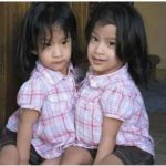 Сестрите-Сабуко–сиамските-близначки,-които-били-разделени-успешно