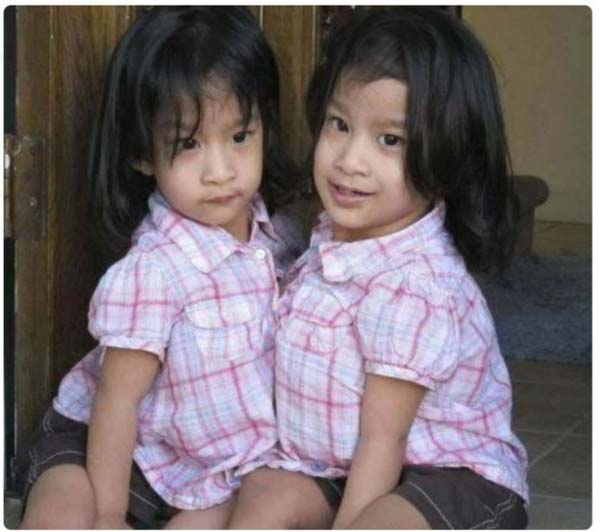 Раждането на сиамски близнаци не е рядко явление За съжаление