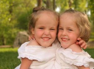 Сиамски близначки били разделени на 4-годишна възраст. Сега вече са на 18 и ето как изглеждат