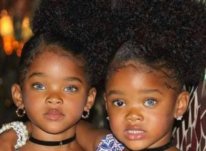 9-годишни-близначки-покориха-интернет-заради-генетична-мутация