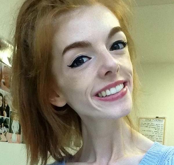 21 годишната Ани Уиндли жителка на Великобритания ядяла само по един