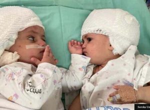 Емоционално! Сиамски близначки се виждат за пръв път, след като хирурзите ги разделили