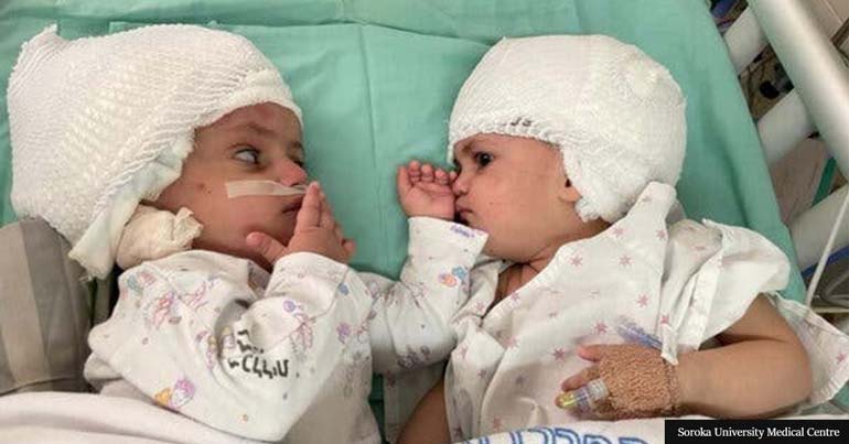 Двете момичета които се родили слепнати в главите били разделени