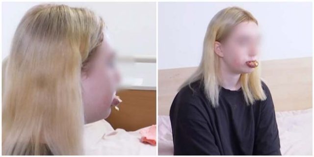 Лайфхак-от-интернет-14-годишно-момиче-реши-да-увеличи-устните-си-и-се-инжектира-с-козметично-масло-(2-снимки)