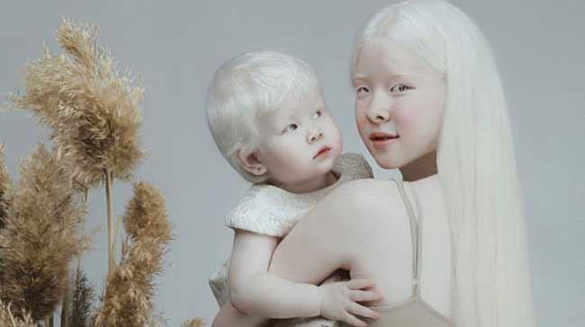 Албинизмът, както е известно, е генетично наследствено заболяване, което се