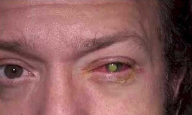 39 годишният Грьошен отбелязва че лявото му око е било особено