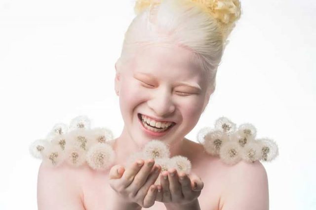 момиче албинос