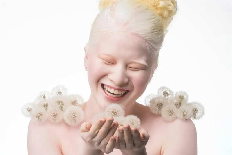 В Китай детето албинос се смята за проклятие и родителите