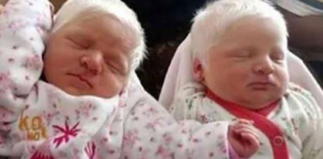 През 2018 г. се родили редки близнаци албиности. Ето как изглеждат днес: