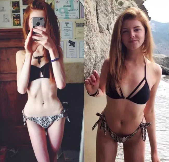 анорексия преди и след 