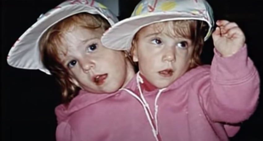 Аби и Британи Хенсел са най известните сиамски близначки в