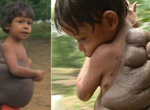 Историята на "момчето-костенурка": как успяло да премахне огромна бенка от гърба си (видео)