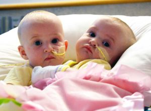 Цели 7 часа 40 медицински лица оперирали тези сиамски близначки. Но вижте ги днес!