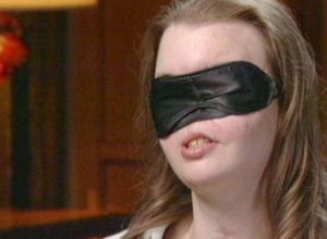 Тя загубила половината си лице през 99 г. Сега докторите й дали причина да свали маската